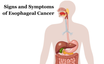 Signs-and-Symptoms-of-Esophageal-Cancer