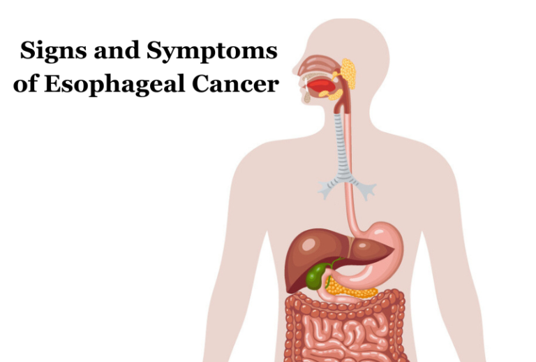 Signs-and-Symptoms-of-Esophageal-Cancer